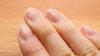 Can Fingernails Reveal Clues to Diet and Lifestyle?