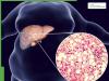 Fatty Liver On Rise In India: Why Young Adults Are Now At Risk Of This Lifestyle Disease