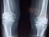 Major arthritis breakthrough: Stanford scientists REGROW cartilage
