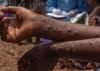 Reunion Island faces Mpox: a first imported case triggers the health response