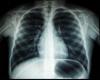 Study links air pollution to specific lung cancer subtypes