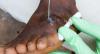 Guinea Worm Disease Reaches All-time Low: Only 10 Human Cases Reported In 2025