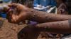 Mpox virus outbreak confirmed in Western Equatoria