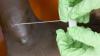 Guinea worm on track to be 2nd eradicated human disease; only 10 cases in 2025