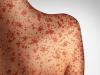 PAHO issues epidemiological alert amid continued measles transmission