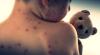 Mongolia’s total number of confirmed measles cases exceeds 14,000