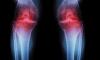 Scientists restore knee cartilage using targeted injection