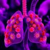 Scientists Discover Possible Immune Evasion Strategy in Early Lung Lesions