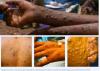 Liberia Prepares for Deadly Strain of Mpox
