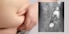 'Worrisome' trend of 11 rising cancers in young adults may have a new explanation, scientists say