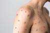 Mpox: Two new confirmed cases in Réunion, the Regional Health Agency (ARS) is increasing vigilance
