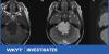 WKYT Investigates: CDC looking into ‘unusual’ number of DIPG cases in Eastern Kentucky