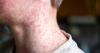 Outbreak travel alerts as 19 countries hit with viruses and diseases May 2026