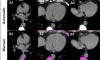 AI tools extract hidden health insights from routine chest imaging