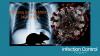 2 Hantavirus Outbreak on an Atlantic Cruise Ship: Facts, Figures and Public Health Implications