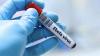 Ebola Outbreak in Congo Kills 87 Amid Spread Fears