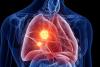 A Rare and Deadly Cancer May Have an Unexpected New Vulnerability