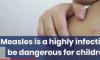 Belize Reports 8 Measles Cases, Urges Public Vigilance Amid Regional Health Alert