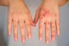 Attovia’s Upsized IPO Brings In $289M to Fund New Kind of Biologic for Immune Disorders