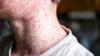 Vaccines Worked for Decades: Why Are Diseases Returning?