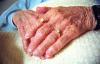 Dementia: don’t wait for crisis to start a conversation
