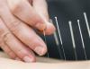 Ear acupuncture may reduce migraine pain, study suggests