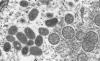 NIH Researchers Charged After Allegedly Smuggling Monkeypox Vials Into United States