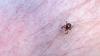 Health officials warn Rhode Islanders to watch for fast-spreading tick tied to lifelong red meat allergy
