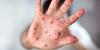 SAFETY ALERT: Measles makes a return to South Carolina