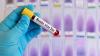 South Carolina reports new measles case in Lowcountry