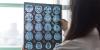 Migraines are linked to accelerated brain aging in regions tied to memory and emotion