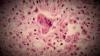 Public Health confirms case of measles in the Moncton area