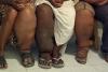 How treating elephantiasis cuts HIV risk in Tanzania