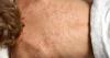 The biggest summer illness threat