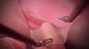 Australian patient undergoes robotic rectal cancer surgery at Delhi NCR hospital