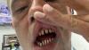 'My Turkey teeth are falling out and it will cost £40k to fix - don't make my mistake'