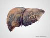 Strategic healthcare interventions bring Japan close to eliminating hepatitis