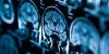 Study finds complex association between dietary fat intake and brain atrophy in older adults