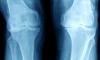 Scientists searched arthritic knees for different diseases and found something unexpected