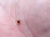 Vaccines, antibody shots, and pills: How scientists are trying to prevent tick-borne diseases