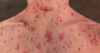 Wyoming Health confirms third measles case in Teton County this year