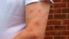 Tropical Mosquitoes Could Spread Imported Diseases in Bulgaria: How to Protect Yourself?