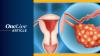 <![CDATA[EU Approval Reccomended by CHMP for Senaparib in First-Line Advanced Ovarian Cancer]]>