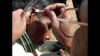 Expert warns against unsafe ear-cleaning practices