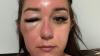 Woman trapped in Greece after developing 'eye bags' on holiday
