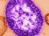 2 new measles cases reported in Chester County as regional Pennsylvania outbreak grows