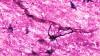 Two People With Severe Autoimmune Disease in Remission After Immune 'Reset'