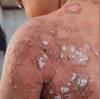 Gaza: Over 9,000 skin disease cases in two weeks