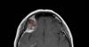Surgeons remove brain tumour through eyelid in Irish medical first