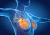 <![CDATA[GLP-1 Receptor Agonists and Cancer: Renewed Momentum for Metabo-Oncology]]>